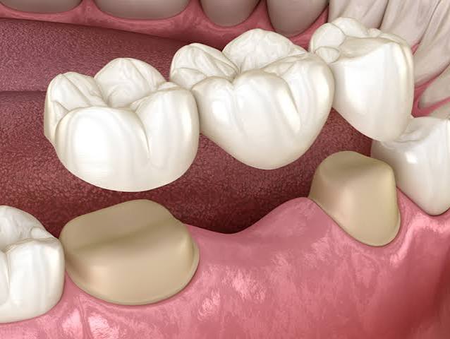 Dental Bridges at Bambi Dental Clinics